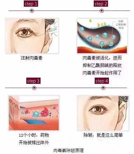 玻尿酸注射后数月肿胀现象探究