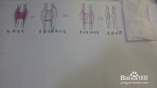 耻骨骨折的愈合过程与骨痂形成，几个月的观察与理解