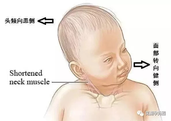 五个月宝宝脖子往左歪，原因、应对措施与关注重点